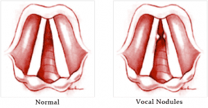 an image of the vocal chords with and without vocal nodules